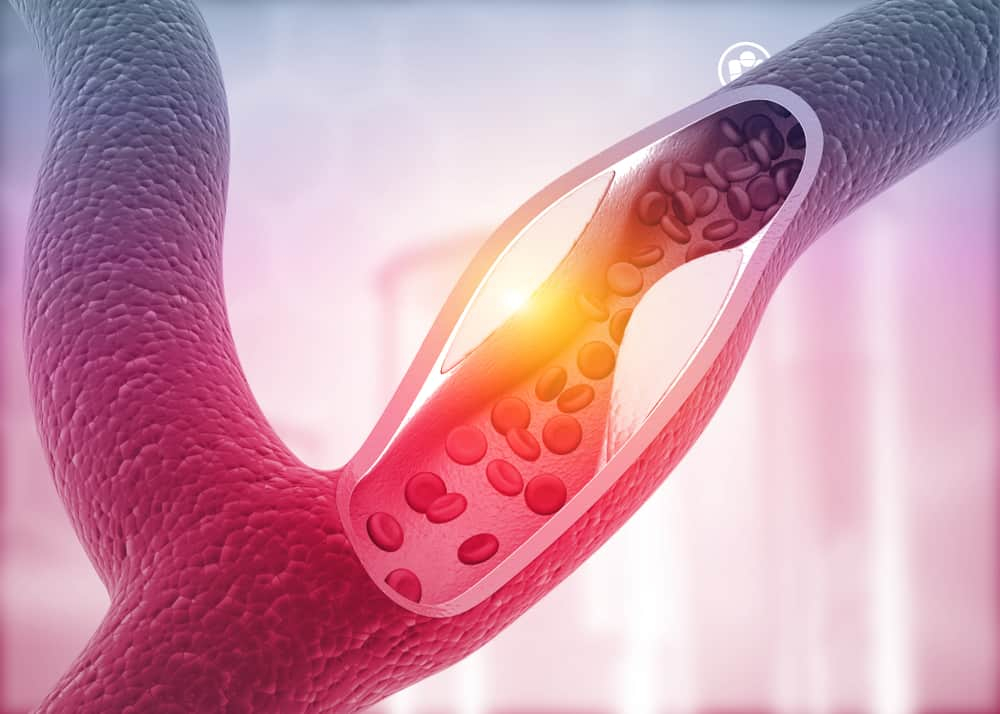 एथेरोस्क्लेरोसिस रिवर्सल : क्या मुमकिन है इस बीमारी को ठीक करना?