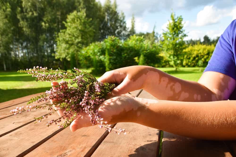 जानिए विटिलिगो का आयुर्वेदिक इलाज और घरेलू उपाय यहां!
