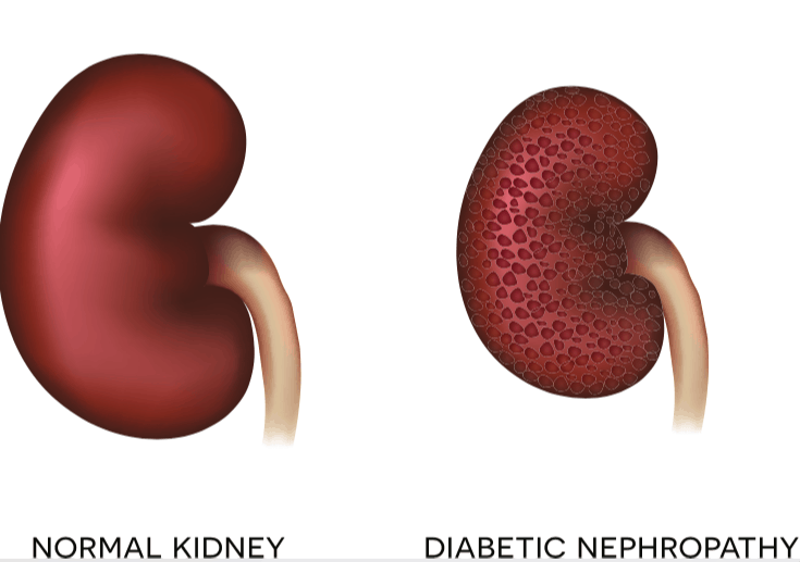 डायबिटिक नेफरोपैथी में एसीई इनहिबिटर्स ड्रग्स से जुड़ी जानकारी है यहां!