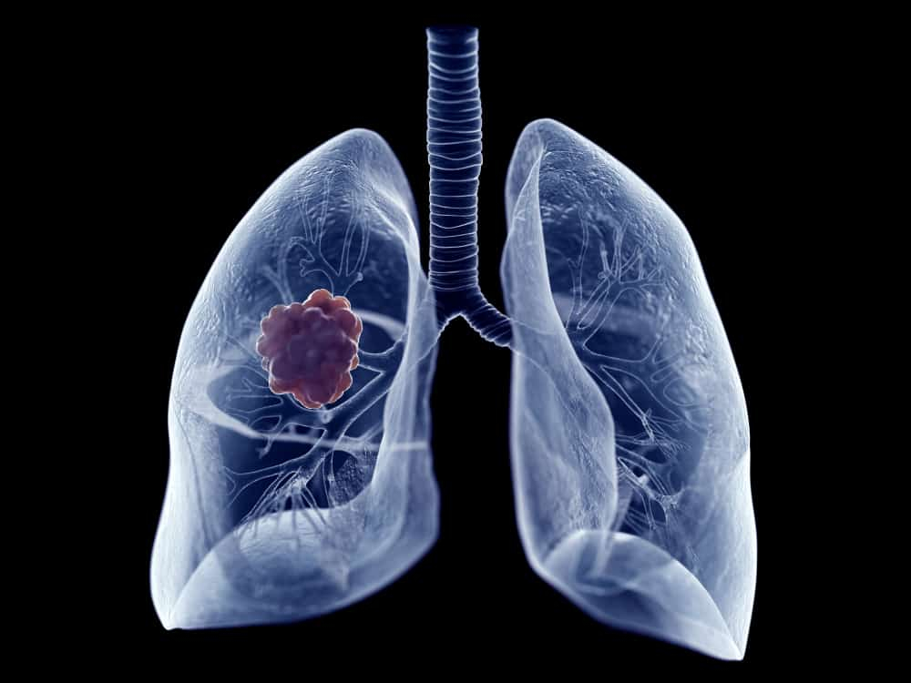 COPD और लंग कैंसर : क्या हैं दोनों में कनेक्शन?