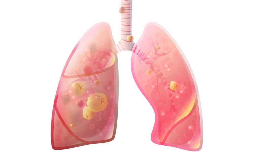 स्टेज 3 लंग कैंसर के लक्षणों को कुछ ऐसे किया जा सकता है मैनेज!