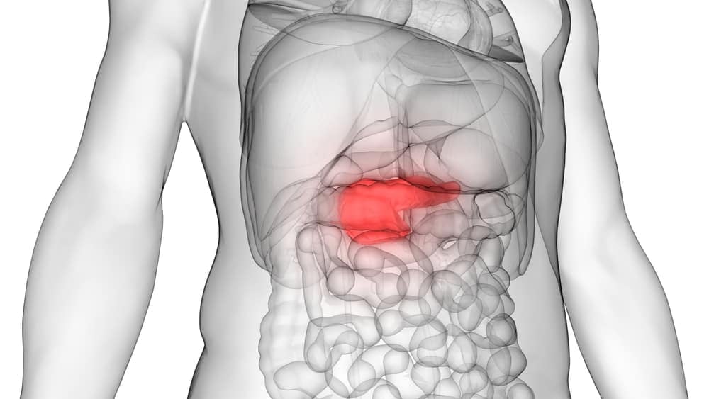स्टेज 4 पैंक्रियाटिक कैंसर: कैंसर के लक्षणों और इलाज को समझें यहां!