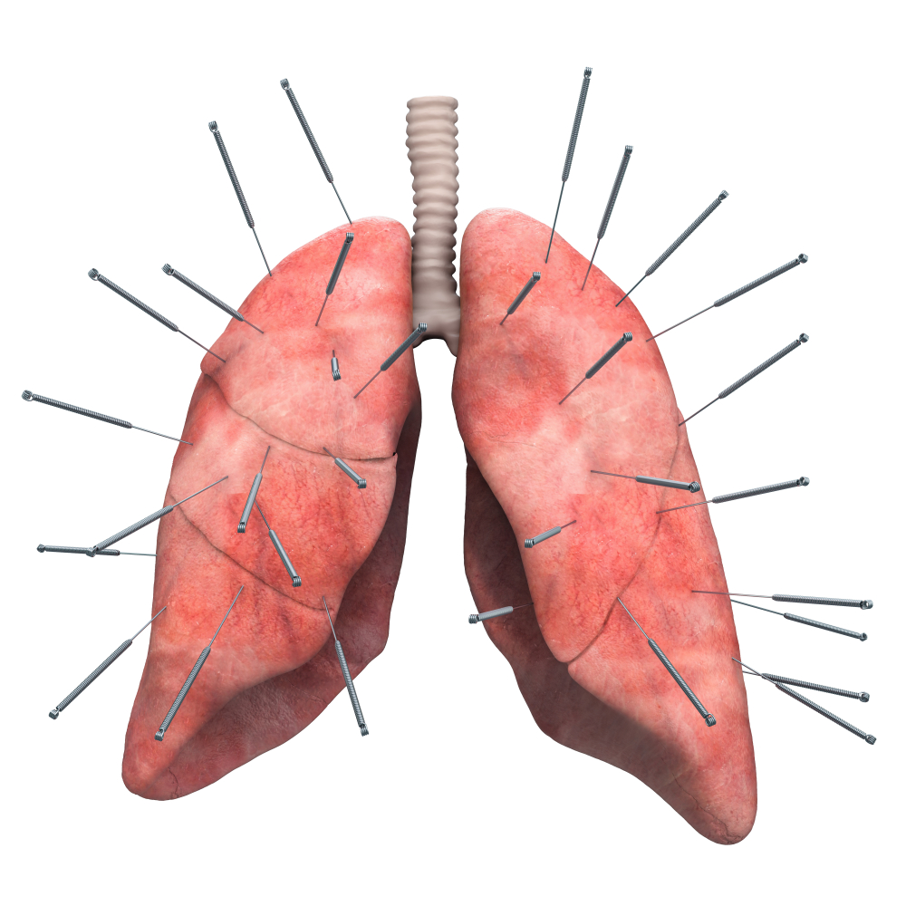 लंग कैंसर में क्या एक्युपंक्चर दिखाता है अपना असर?