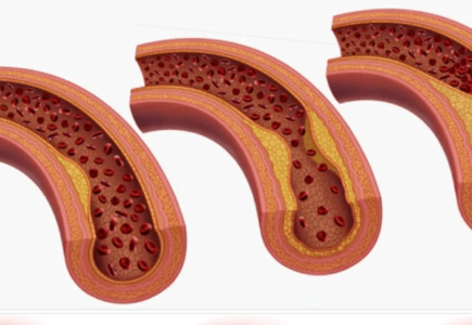 Carotid atherosclerosis: इस बीमारी में ब्रेन तक नहीं पहुंच पाता है खून, बढ़ जाता है स्ट्रोक का खतरा!