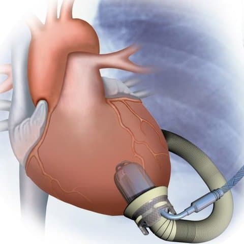 वेंट्रिक्युलर असिस्ट डिवाइसेस: दिल के काम को आसान करने के लिए किया जाता है इनका प्रयोग