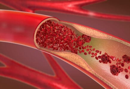 पॉलीआर्टराइटिस नोडोसा: इस बीमारी में आर्टरीज में आ जाती है सूजन, होते हैं गंभीर परिणाम