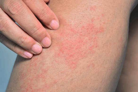 डायबिटीज पेशेंट्स को डायबिटिक डर्मोपैथी का खतरा होता है ज्यादा!