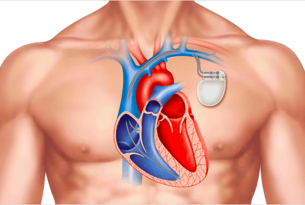 दिल की जरूरतों को पूरा कर सकती है पेसमेकर डिवाइस!