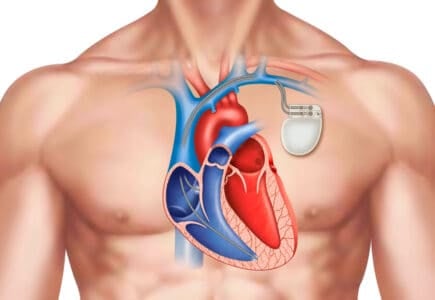 कंजेस्टिव हार्ट फेलियर में पेसमेकर क्यों लगाया जाता है?