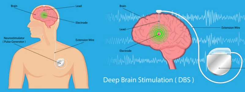 ब्रेन स्टिमुलेशन डायबिटिक पेशेंट्स को क्या पहुंचा सकता है फायदा?