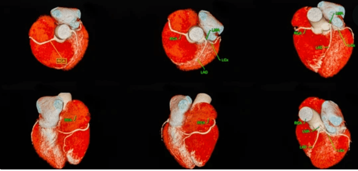 Acute coronary syndrome: एक्यूट कोरोनरी सिंड्रोम किस तरह से करता है प्रभावित?