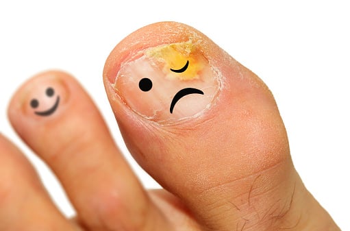 Fungal Nail Infection: फंगल नेल इंफेक्शन से कैसे बचें?