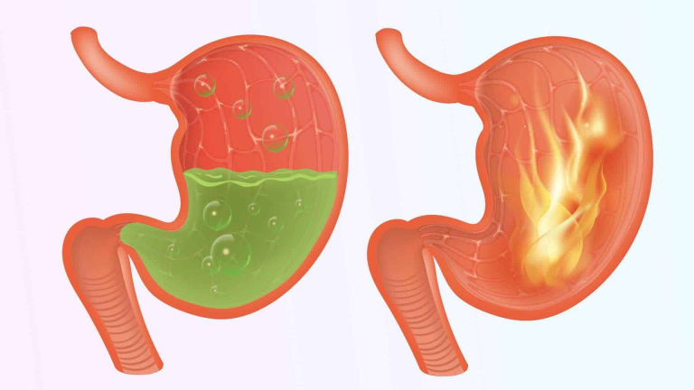 Erythematous Mucosa: एरीथेमेटस म्यूकोसा के बारे में जानें विस्तार से
