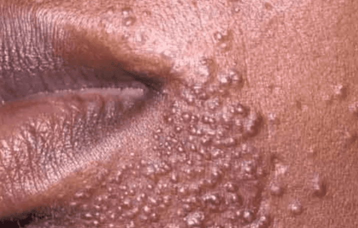 Perioral Dermatitis: पेरिओरल डर्माटाइटिस की समस्या क्या है, जानिए क्या होता है इसका ट्रीटमेंट?