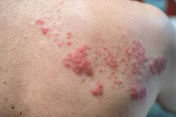 Skin Lesions: स्किन लीजन क्या है? जानिए स्किन लीजन का कारण, इलाज और घरेलू उपाय 