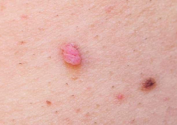 Non Cancerous Skin Tags: जानिए नॉन कैंसरस स्किन टैग से जुड़ी महत्वपूर्ण जानकारी!