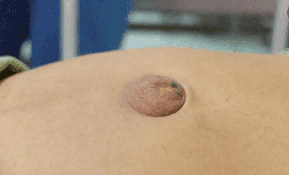 एब्डॉमिनल लम्प (Abdominal Lump) की समस्या क्यों होती है, जानिए इसके कारण क्या हैं?