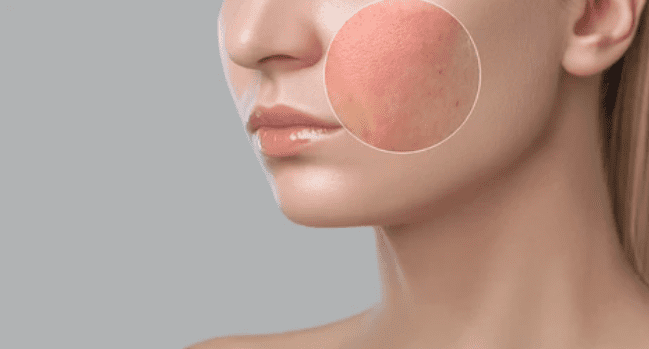 Red skin: रेड स्किन की समस्या किन कारणों से होती है, क्या इससे पाया जा सकता है छुटकारा?