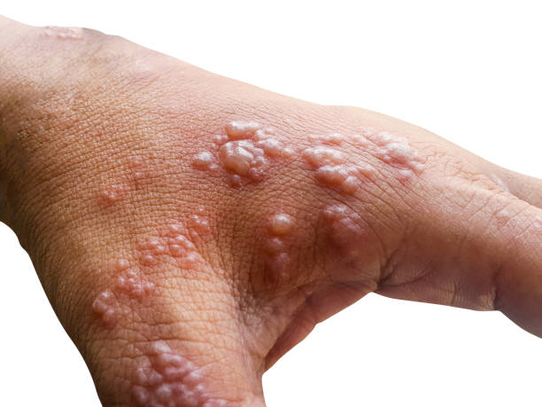 Herpes Skin Rash: हर्पीस स्किन रैश की समस्या क्या है? जानिए इसके लक्षण, कारण और इलाज 