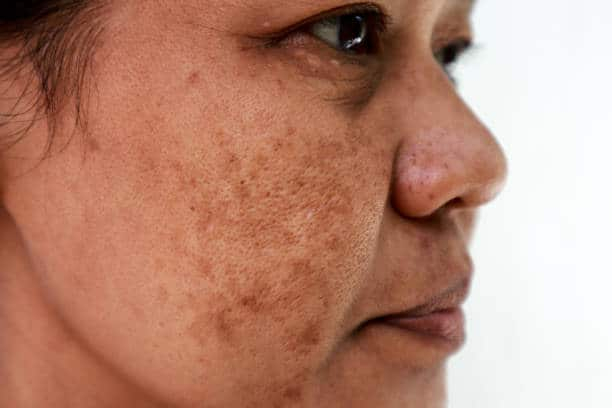 Melasma On Dark Skin: 7 टिप्स दूर कर सकती है डार्क स्किन पर मेलास्मा की समस्या!