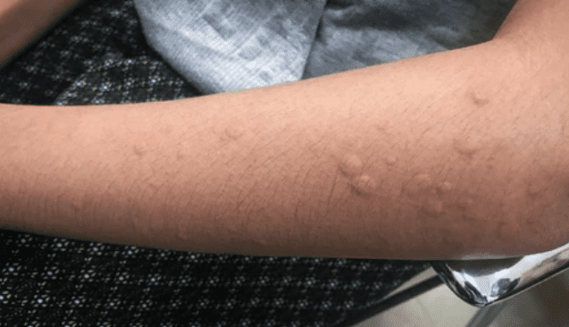 स्किन में खुजलीदार बम्प्स के क्या हो सकते हैं कारण?