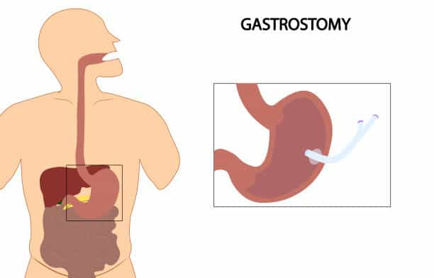 Gastrostomy: गैस्ट्रोस्टॉमी क्या है और इसकी जरूरत कब पड़ सकती है?