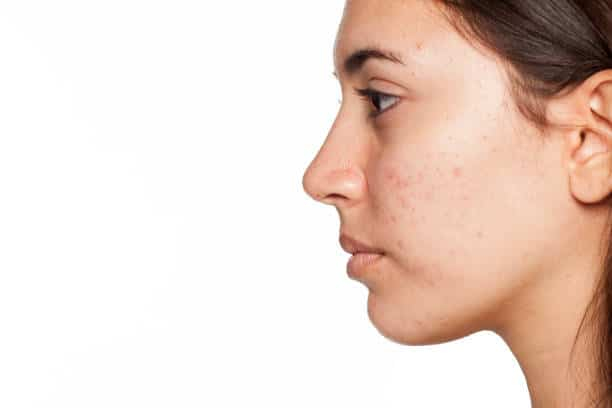 Acne Face Maps: जानिए एक्ने फेस मैप्स के बारे में यहां!