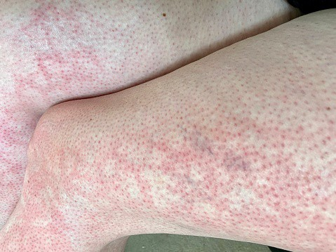 Mottled Skin: त्वचा पर इन स्पॉट्स के उपचार से पहले जानें क्या हैं इनके कारण?