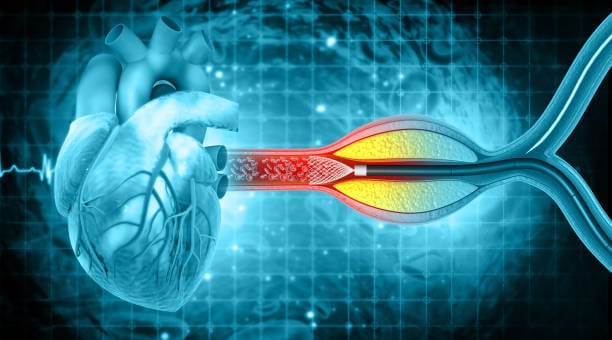 हार्ट एंजियोप्लास्टी और स्टेंट प्लेसमेंट: ये है दिल का मामला, ना बरतें लापरवाही! 