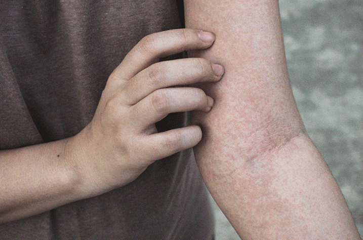 Non-blanching rash in adults and children: बच्चों और वयस्कों में नॉन ब्लेंचिंग रैश क्या होते हैं?