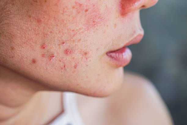 PCOS, Acne, And Acne Treatment: पीसीओएस, एक्ने और एक्ने ट्रीटमेंट के बारे में समझें यहां!