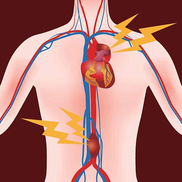 Abdominal Aortic Aneurysm: एब्डॉमिनल एऑर्टिक एन्यूरिज्म से जुड़ी पूरी जानकारी यहां!