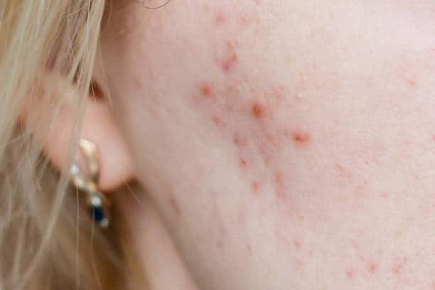 Nodular Acne: नोड्यूलर एक्ने क्या है? जानिए इसके लक्षण, कारण और इलाज!