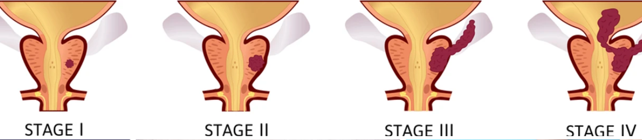Stage 4 Prostate Cancer: स्टेज 4 प्रोस्टेट कैंसर के दौरान कैसे मिलते हैं बीमारी के लक्षण?