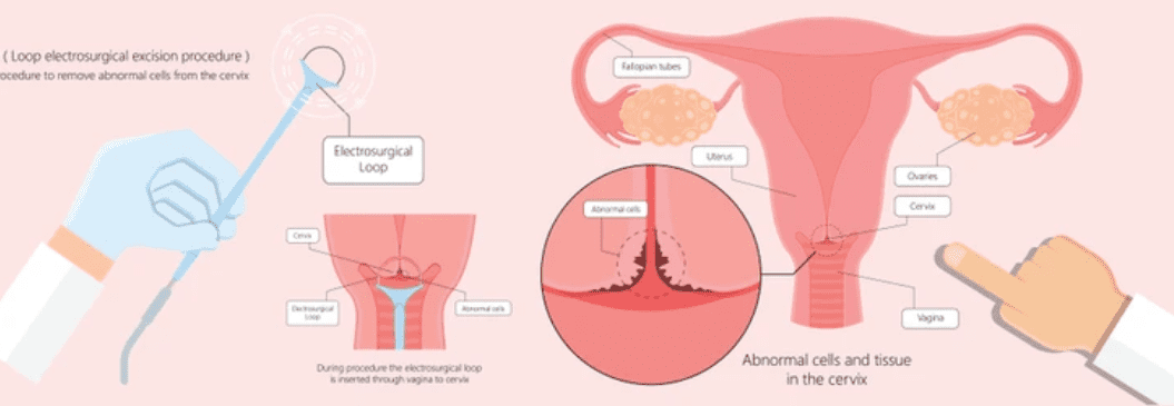 Cervical Biopsy: कैसे की जाती है सर्वाइकल बायोप्सी, जानिए इसके बारे में अहम जानकारी!