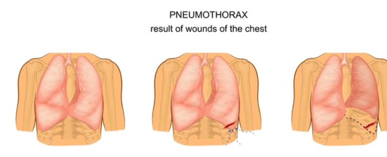 Air Embolism: एयर एम्बालिज्म की समस्या का आखिर क्यों करना पड़ता है सामना?