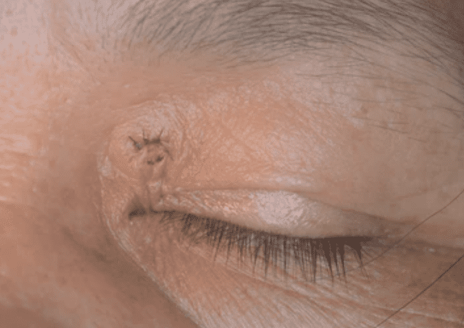 Cholesterol Deposits In The Eyes: आंखों में जम जाए कोलेस्ट्रॉल, तो क्या हो सकती हैं परेशानियां?