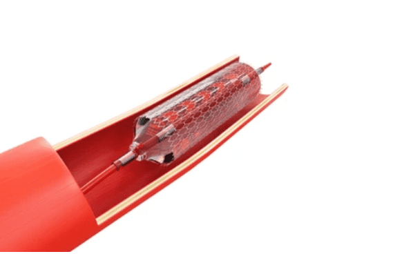 Swan-Ganz catheterization: स्वान-गेंज कैथेटेराइजेशन क्या है, जानिए इसका प्रोसीजर