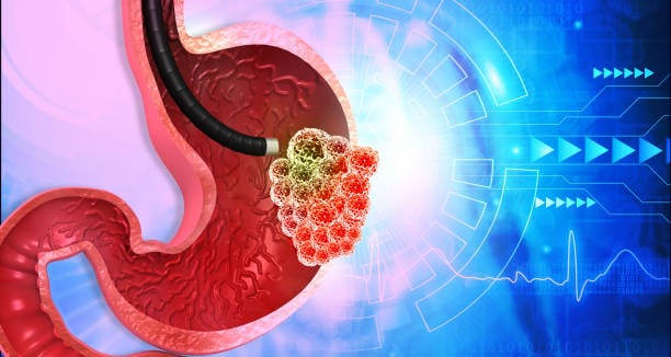 Herbs and Supplements for Acid Reflux: जानिए एसिड रिफ्लक्स में हर्ब्स और सप्लिमेंट्स के बारे में यहां!