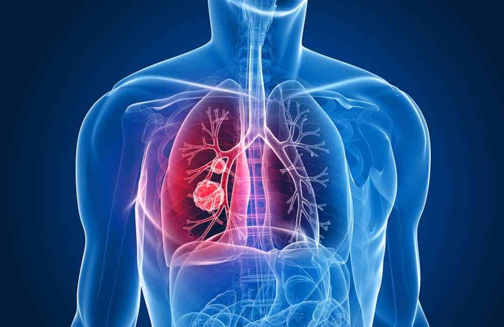 Lung cancer treatment: लंग कैंसर ट्रीटमेंट कैसे किया जाता है, जानिए इसके बारे में विस्तार से!