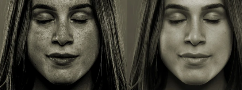 Sunspots On The Face: फेस में सनस्पॉट की समस्या हो जाए, तो क्या किया जाए उपाय?