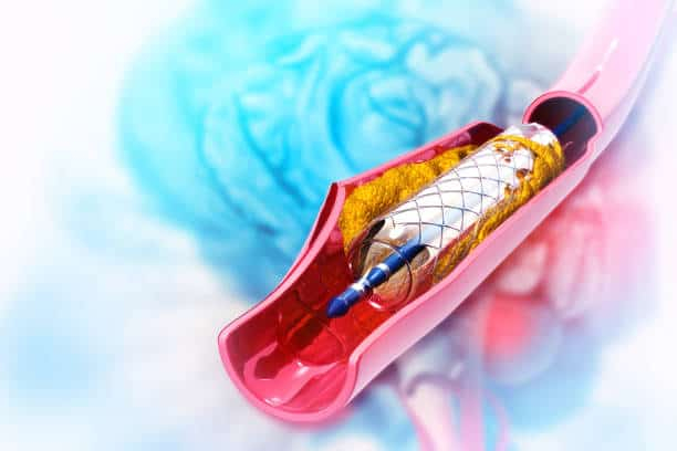 Stent: स्टेंट कितनी देर तक काम कर सकता है? पाएं इस बारे में पूरी जानकारी