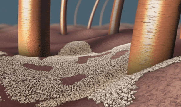 KOH Exam For Fungal Infections: फंगल इंफेक्शन के लिए केओएच एक्जाम कैसे किया जाता है?