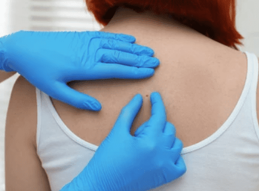 Blue nevus: शरीर में पाया जाने वाला ब्लू नेवस क्या है किसी खतरे की निशानी?