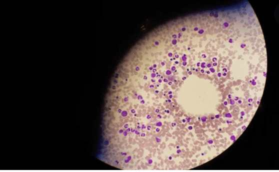 Chronic Myeloid Leukemia: क्रॉनिक माइलॉयड ल्यूकेमिया क्या है, जानिए इसके लक्षण