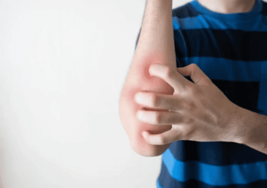 Lymphoma rash : लिम्फोमा रैश किन कारणों से होता है, जानिए कैसे किया जा सकता है इस समस्या का निदान?