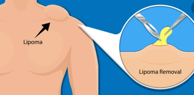 लिपोमा (lipoma) क्या हो सकता है कैंसर की निशानी, जानिए इसके बारे में खास जानकारी!