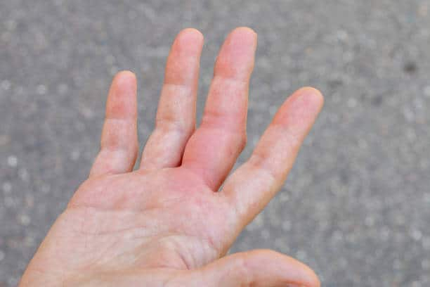 Palmar Erythema: हथेलियों के लाल होने का कारण कहीं पामर एरिथेमा तो नहीं!