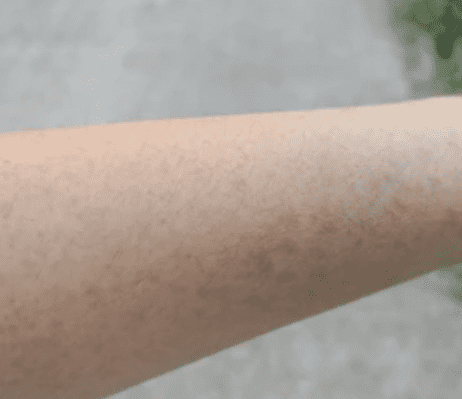 Leukemia Rash: क्या होते हैं ल्यूकेमिया रैश और ये किन समस्याओं का बन सकते हैं कारण?