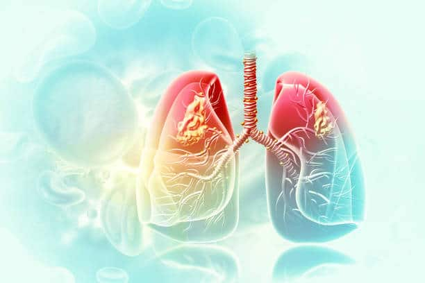 ALK positive lung cancer: एएलके पॉसिटिव लंग कैंसर क्या है? जानिए इसके लक्षण और इलाज!